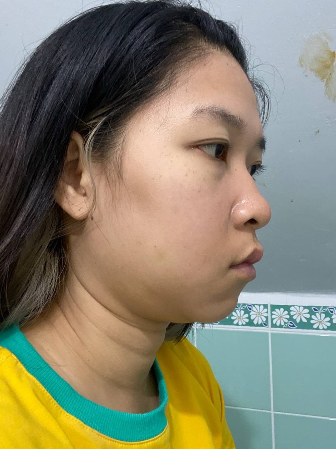 ลดความอ้วนแต่เหนียงไม่ลด ก็กำจัดด้วยการดูดไขมันที่ ลดความอ้วนแต่เหนียงไม่ลด ก็กำจัดด้วยการดูดไขมันที่